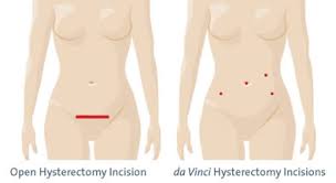 hysterectomy incisions